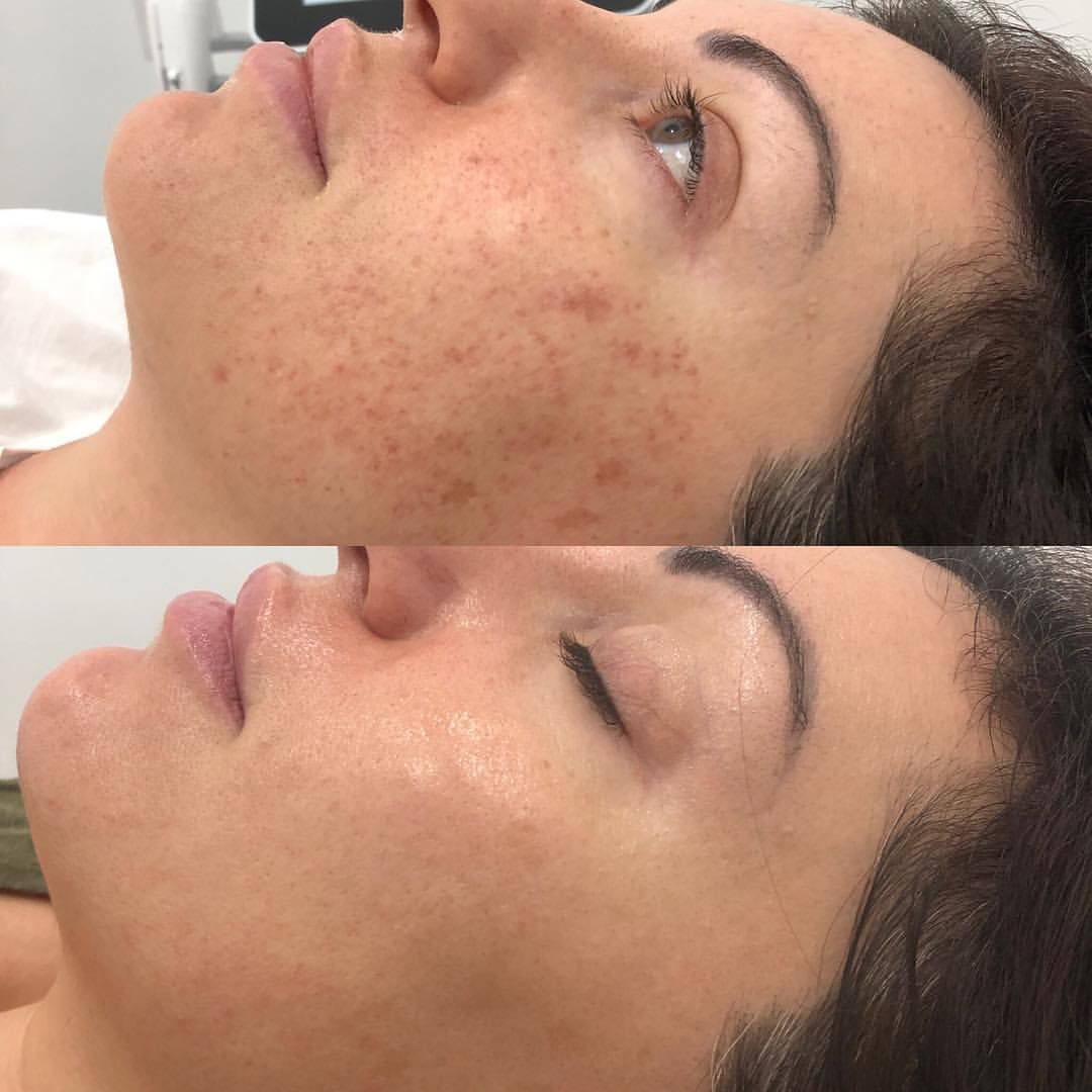 Resultado antes y después de un tratamiento para manchas